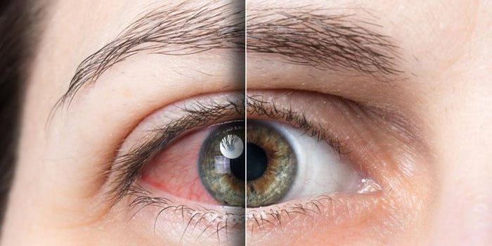 Ardor en los ojos, por qué ocurre y cómo aliviarlo.-Ópticas Lafam