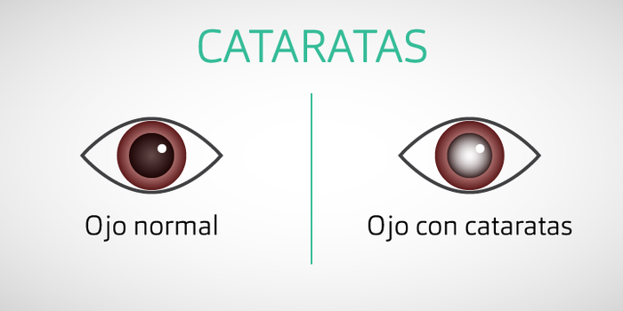 Cataratas en los ojos