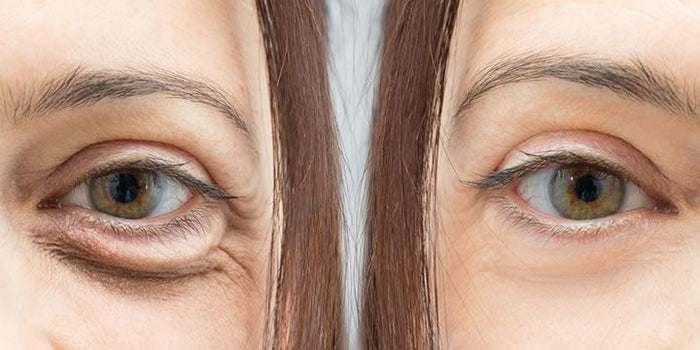Una solución definitiva a las bolsas en los ojos: la Blefaroplastia-Ópticas Lafam