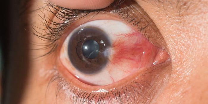 Qué es el Pterigio y cómo tratarlo-Ópticas Lafam