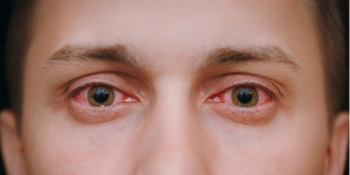 Alergias en los ojos