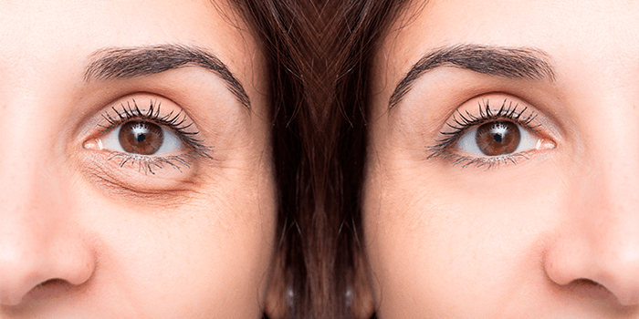 ¿Qué son y por qué salen las ojeras?